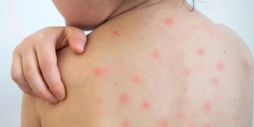 হামের উপসর্গে আরও ৪ শিশুর মৃত্যু, তিন বিভাগে বাড়ছে উদ্বেগ