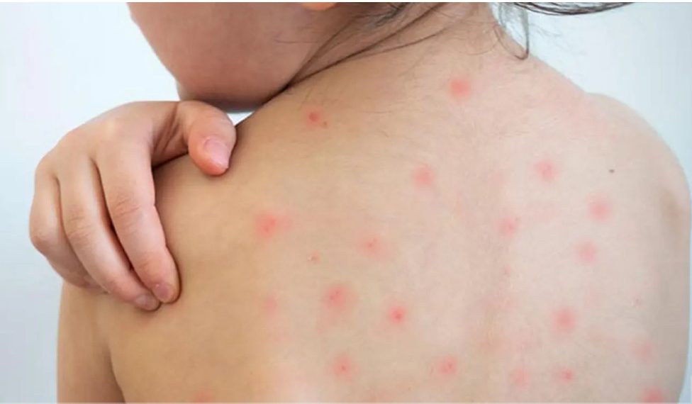 হামের উপসর্গে আরও ৪ শিশুর মৃত্যু, তিন বিভাগে বাড়ছে উদ্বেগ